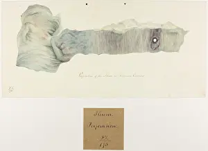 1826: Perforation of the Ileon in Chronic Enteritis