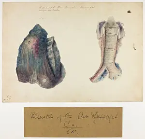 Ucl Library Services Digital Collections: Perforation of the Pleura and Pneumothorax