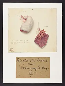 Perforation: Perforation of the Pulmonary Artery