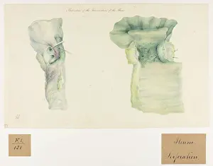 1827: Perforation of the Termination of the Ileon