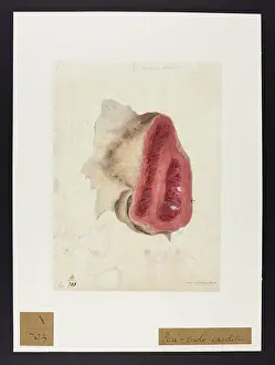 Blank: Peri-endo-carditis