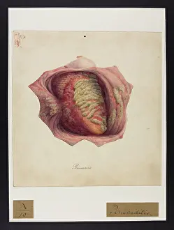 Hopital: Pericarditis