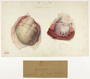 Partly: Pericarditis: Hypertrophy of Left Ventricle