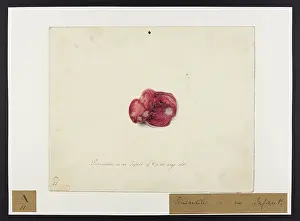 Enfans: Pericarditis (Infant)
