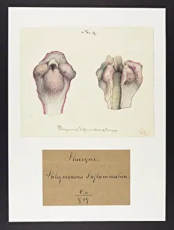 Mons: Pharynx: Phlegmonous Inflammation