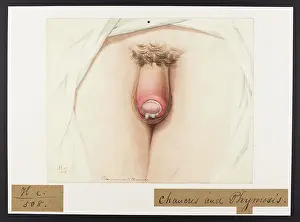Hospice: Phimosis and Chancre