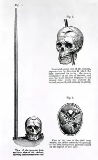 Comparative: Phineas Gage's skull and iron bar