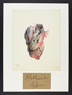 Phthisis: Phthisis