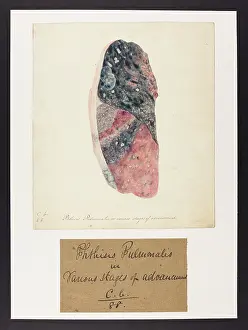 Stages: Phthisis Pulmonalis