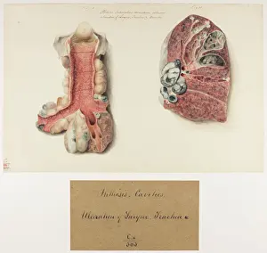 Ucl Library Services Digital Collections: Phthisis, Tuberculous Excavations, Ulceration of Larynx