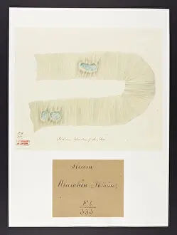 Ileum: Phthisis: Ulceration of the Ileum