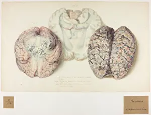 Dieu: Pia Mater: Inflammation