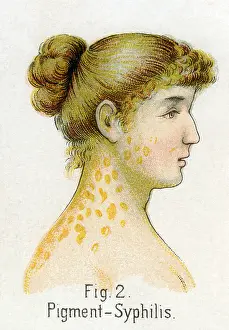 Genital: Pigment syphilis, 1902