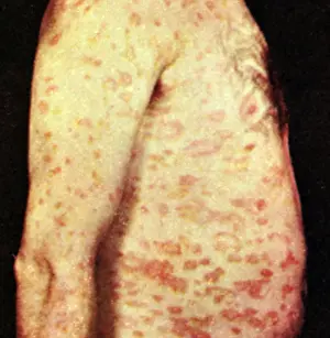Acute: Pityriasis Rosea