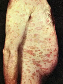 Acute: Pityriasis Rosea