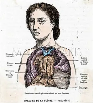 Pleurisy: PLEURISY SUFFERER
