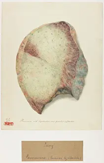 Pneumonia: Pneumonia