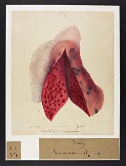 1836: Pneumonia Occurring in Typhus and Interlobular Emphysema