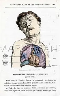 Unhappily: PNEUMONIA SUFFERER