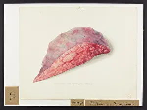 1826: Pneumonia and Tubercular Phtisis