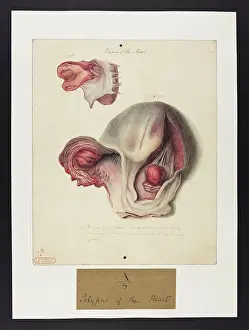 1827: Polypus of the Heart
