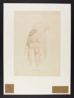 Blank: Pompholyx