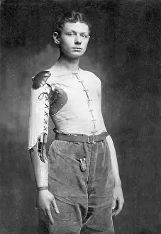 Prosthetic: Prosthesis of a German war veteran, 1915
