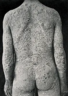Pathology: Psoriasis, Skin Disease