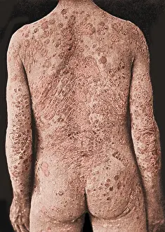 Colorization: Psoriasis, Skin Disease
