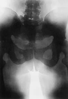 Xray: Pubiotomy, Collotype from X-Ray
