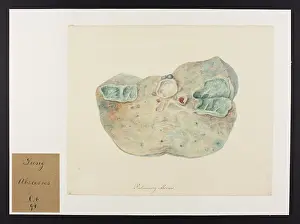 Pulmonary: Pulmonary Abscess