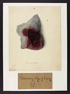 1826: Pulmonary Apoplexy