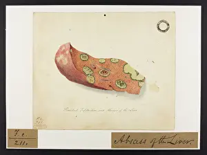Liver: Purulent Infiltration and Abscess of the Liver