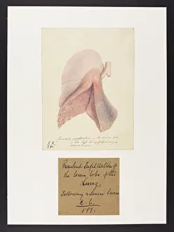 1836: Purulent Infiltration of the Lung