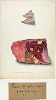 Lungs: Pus in the Tissue and Veins of the Lung