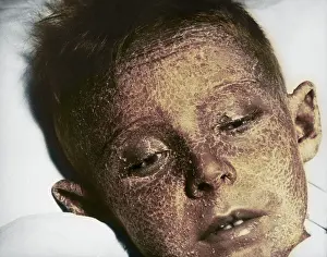 Peeling: Radiation Injury