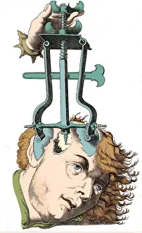 Trephination: Removing Bone with Trochlea Bipes, 16th Century