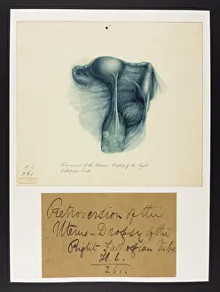 Uterus: Retroversion of Uterus: Dropsy of Fallopian Tube