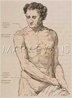 Rheumatism: RHEUMATISM/1883