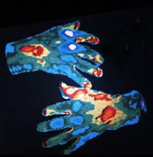 Pathology: Rheumatoid Arthritis, Hands, Early Thermogram