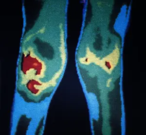 Pathology: Rheumatoid Arthritis, Knees, Early Thermogram
