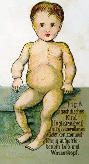 Illnesses: Rickets, 1902