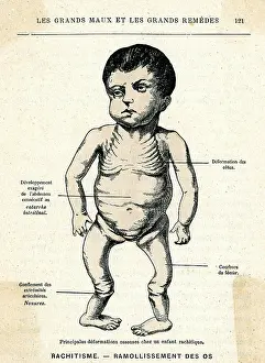Ailments: RICKETS PATIENT