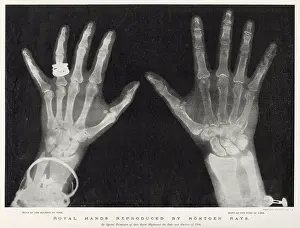 Roentgen: Royal Hands Reproduced by Rontgen Rays
