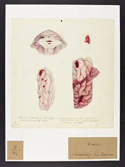 Brain: Rupture of the Vessels of the Brain