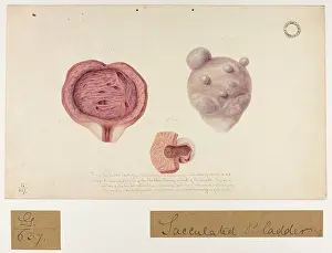 Bladder: Sacculated Bladder