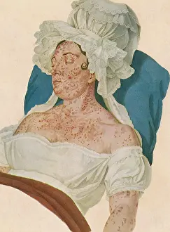 Symptom: Scarlet Fever