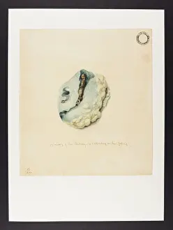 Pelvis: Scirrhus of the Kidney, Calculus in the Pelvis