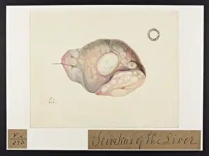 Liver: Scirrhus of Liver