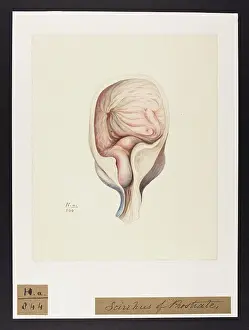 Prostate: Scirrhus of Prostate